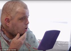 Герою пересадили лицо байкера